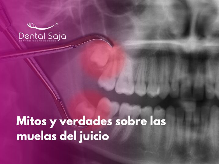 Mitos y verdades sobre las muelas del juicio